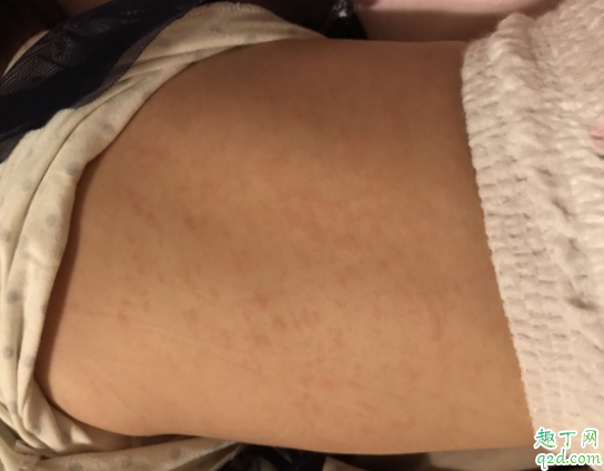 幼儿急疹有传染性吗 幼儿急疹会得第二次吗