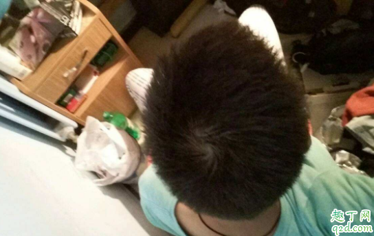 如何预防秃顶掉发 为什么男生比女生容易秃头