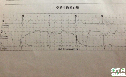 体检心律不齐有危险吗 心电图窦性心律不齐有什么危害