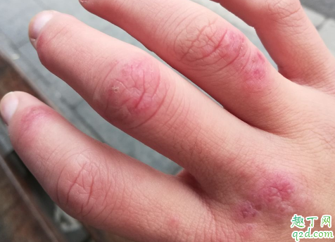 手起冻疮能用冷水洗手吗 每年都长冻疮怎么办
