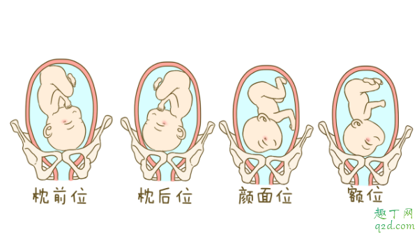 怀孕七个月宝宝臀位怎么纠正 单胎臀位不能顺产吗