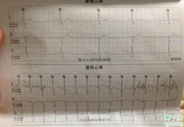 心律失常做什么检查确诊 心律失常是心跳快还是慢