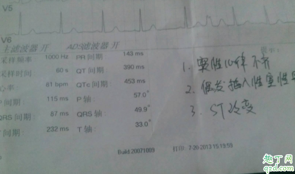心律失常做什么检查确诊 心律失常是心跳快还是慢