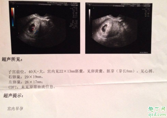有卵黄囊就一定会有胎心胎芽吗 卵黄囊什么时候能看到