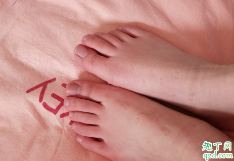 手冻了用什么冻疮膏最好 冻疮怎么治才能去根