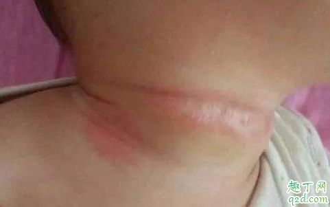 宝宝淹脖子怎么回事 宝宝淹脖子该怎么做