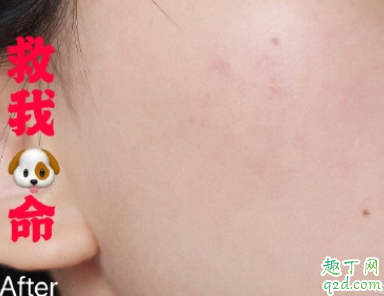芙清祛痘凝胶怎么样 芙清祛痘凝胶使用测评