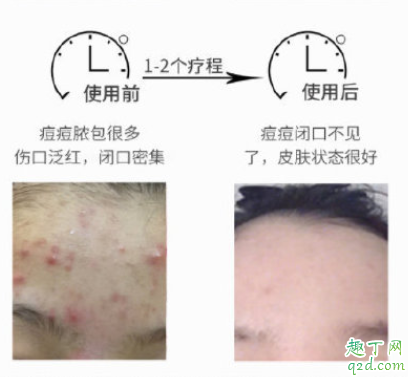 芙清祛痘凝胶怎么样 芙清祛痘凝胶使用测评