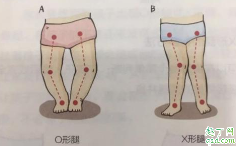 婴幼儿o型腿可以矫正过来吗 婴儿o型腿可以用绑带矫正吗