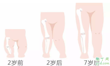 婴幼儿o型腿可以矫正过来吗 婴儿o型腿可以用绑带矫正吗