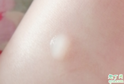 星期四茶树祛痘凝胶爆痘怎么办 星期四茶树凝胶用了蜕皮怎么回事