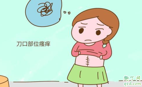 剖腹产到底是美容线好还是拆线好 剖腹产拆线和不拆线的区别哪个好