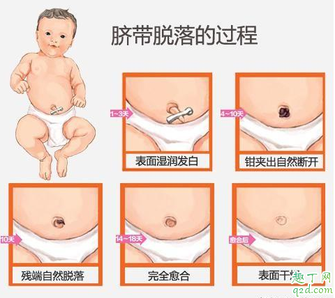新生儿肚脐多长时间能痊愈 脐带未脱落前能给宝宝穿纸尿裤吗
