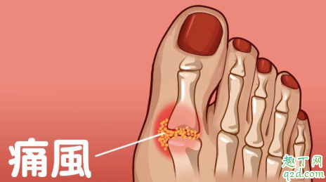 感觉骨头疼是不是痛风 骨头按着疼怎么回事