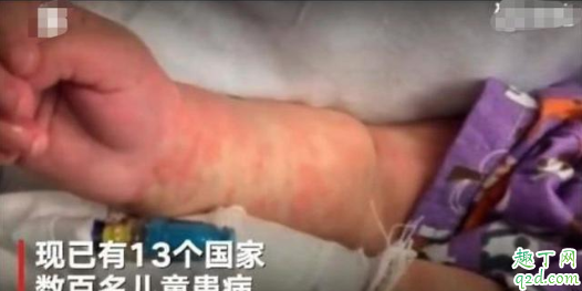 儿童怪病有什么症状