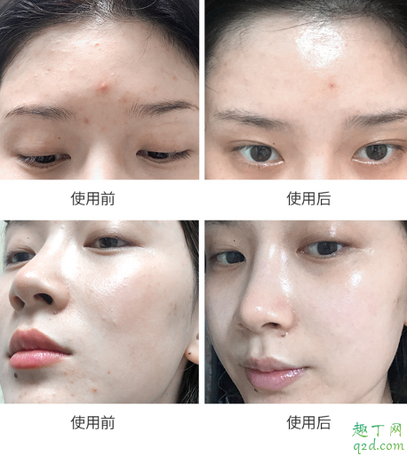 科娜蓝面霜爆痘真的可以修复好吗 科娜蓝面霜孕妇能用吗